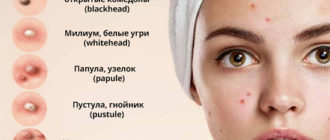 Виды прыщей на лице, теле и руках